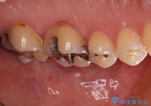 何度も外れてしまう銀歯 ゴールドインレーによる虫歯治療の治療前