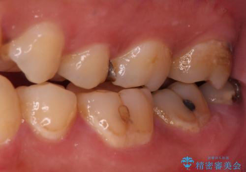 何度も外れてしまう銀歯 ゴールドインレーによる虫歯治療の治療前