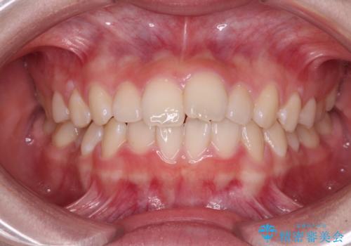 前歯のデコボコを治したい 高校生のインビザライン治療の症例 治療前