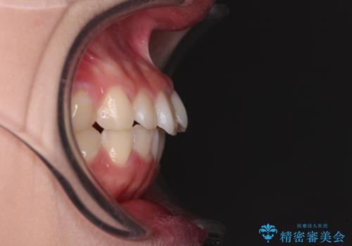 前歯のデコボコを治したい 高校生のインビザライン治療の治療前