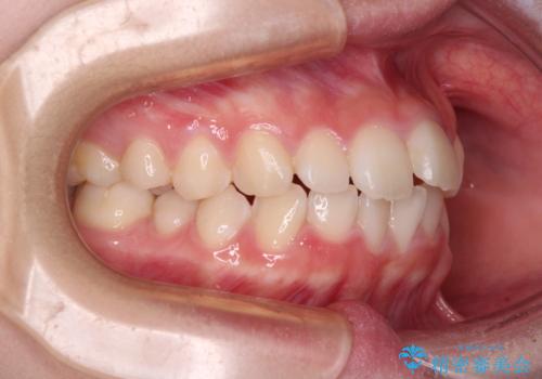 前歯のデコボコを治したい 高校生のインビザライン治療の治療前