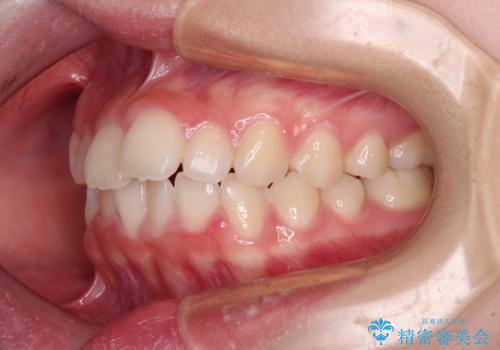 前歯のデコボコを治したい 高校生のインビザライン治療の治療前