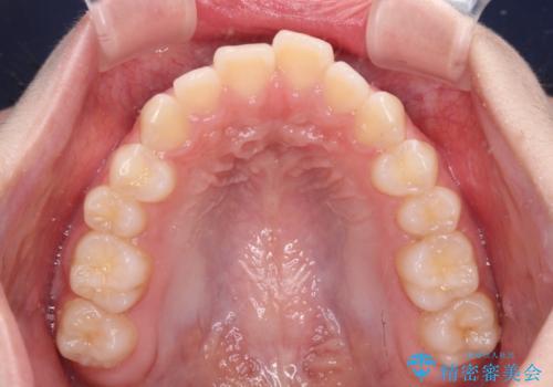 前歯のデコボコを治したい 高校生のインビザライン治療の治療前