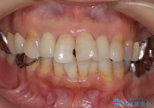 50代女性 前歯のつめものがとれた これを機に前歯をきれいにしたいの治療前