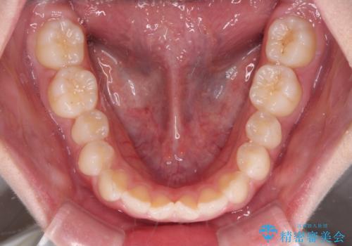 前歯のデコボコを治したい 高校生のインビザライン治療の治療前