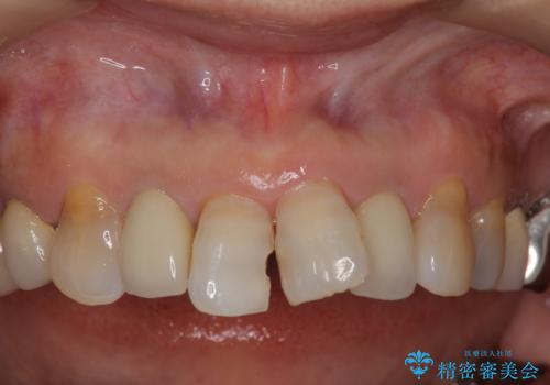 50代女性 前歯のつめものがとれた これを機に前歯をきれいにしたいの治療前