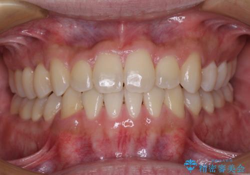 前歯のクロスバイトをワイヤー矯正で　結婚式までに治したいの症例 治療後