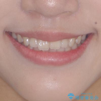前歯のデコボコを治したい 高校生のインビザライン治療の治療前(顔貌)
