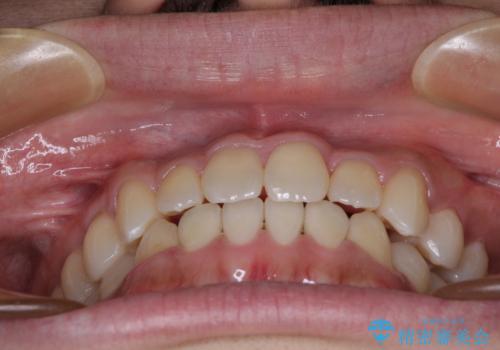 前歯のクロスバイトをワイヤー矯正で 結婚式までに治したいの治療後