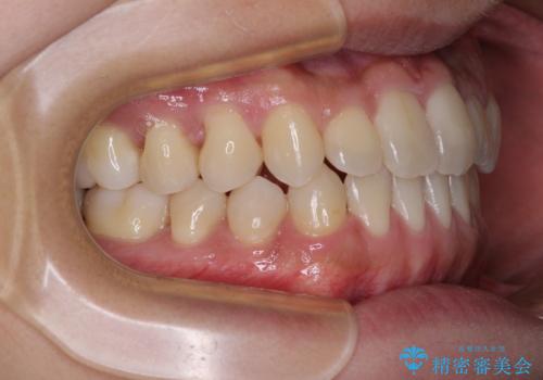 前歯のクロスバイトをワイヤー矯正で 結婚式までに治したいの治療後