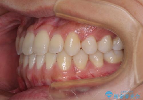 前歯のクロスバイトをワイヤー矯正で 結婚式までに治したいの治療後