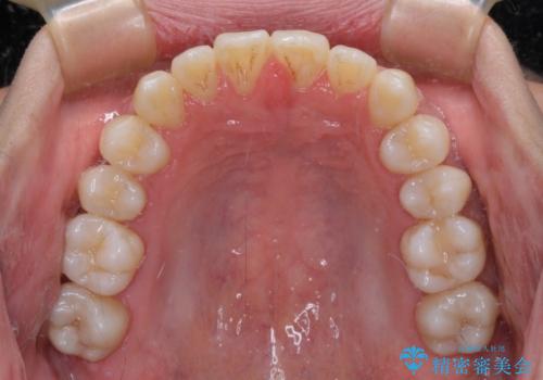 前歯のクロスバイトをワイヤー矯正で　結婚式までに治したいの治療後