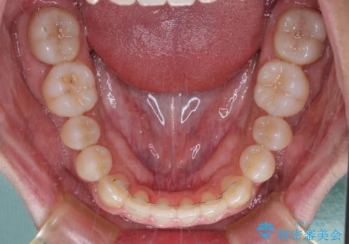 前歯のクロスバイトをワイヤー矯正で 結婚式までに治したいの治療後