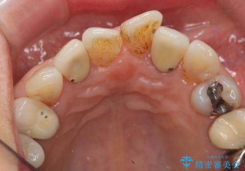 50代女性 前歯のつめものがとれた これを機に前歯をきれいにしたいの治療前
