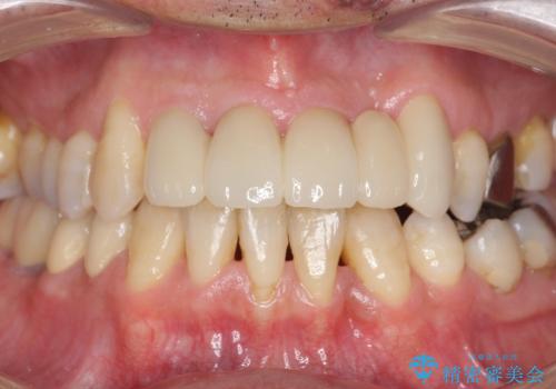 受け口 なんと部分矯正で治るんです!! インプラントを含めた総合歯科治療の症例 治療後