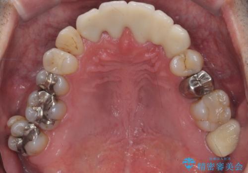 受け口 なんと部分矯正で治るんです!! インプラントを含めた総合歯科治療の治療後