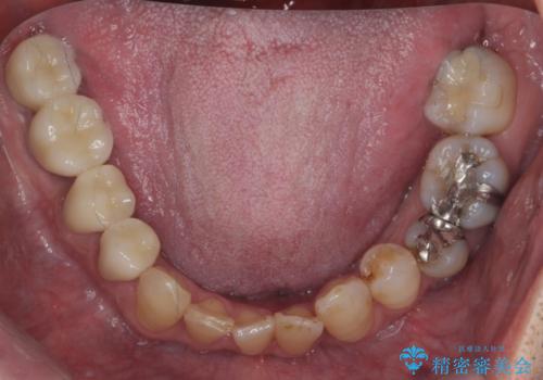 受け口 なんと部分矯正で治るんです!! インプラントを含めた総合歯科治療の治療後