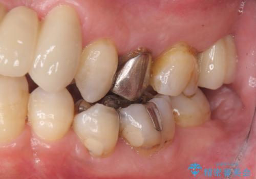 受け口 なんと部分矯正で治るんです!! インプラントを含めた総合歯科治療の治療後