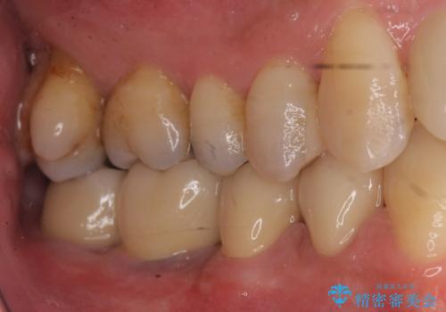 受け口 なんと部分矯正で治るんです!! インプラントを含めた総合歯科治療の治療後