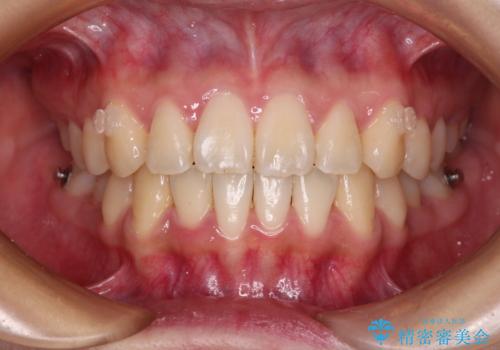 【モニター】捻れた前歯をスッキリと インビザライン矯正治療の治療中