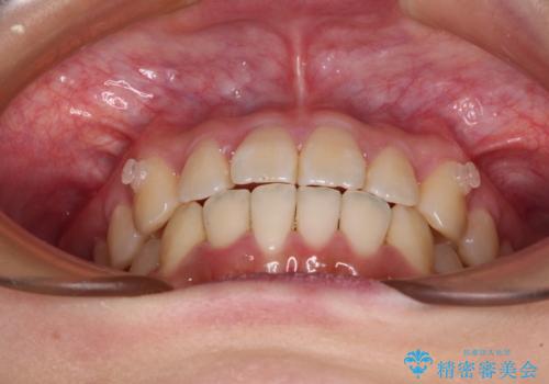 【モニター】捻れた前歯をスッキリと インビザライン矯正治療の治療中