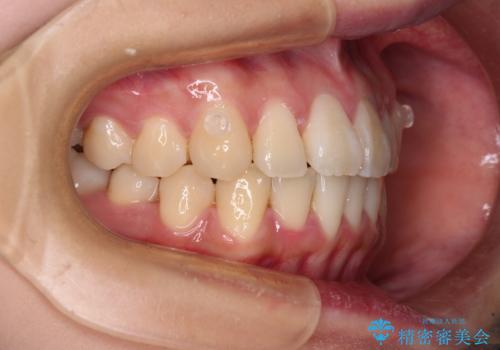 【モニター】捻れた前歯をスッキリと インビザライン矯正治療の治療中