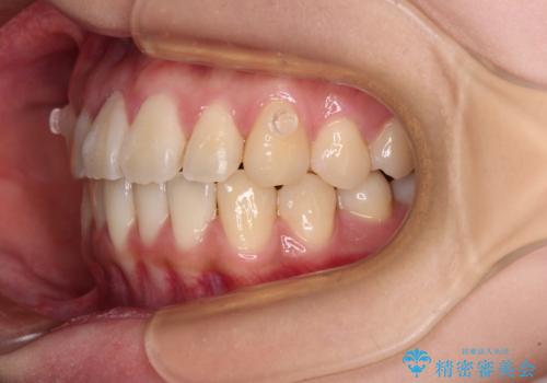 【モニター】捻れた前歯をスッキリと インビザライン矯正治療の治療中