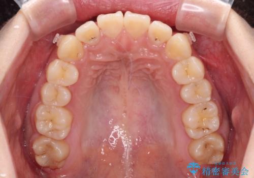 【モニター】捻れた前歯をスッキリと インビザライン矯正治療の治療中