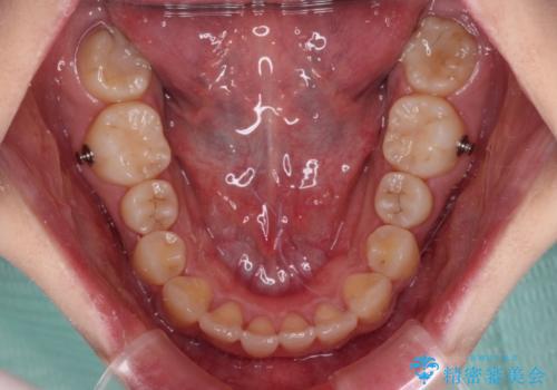 【モニター】捻れた前歯をスッキリと インビザライン矯正治療の治療中