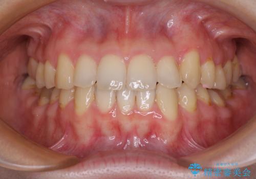 【モニター】1本欠損した下顎前歯と上顎の八重歯 ワイヤー装置で楽して矯正治療の症例 治療後