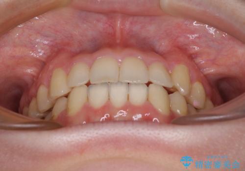 【モニター】1本欠損した下顎前歯と上顎の八重歯 ワイヤー装置で楽して矯正治療の治療後