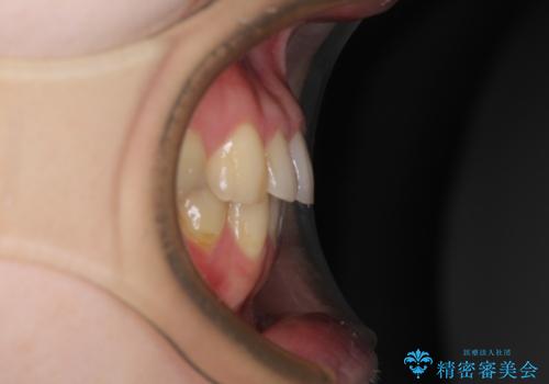 【モニター】1本欠損した下顎前歯と上顎の八重歯 ワイヤー装置で楽して矯正治療の治療後