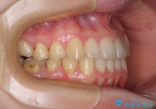 【モニター】1本欠損した下顎前歯と上顎の八重歯 ワイヤー装置で楽して矯正治療の治療後