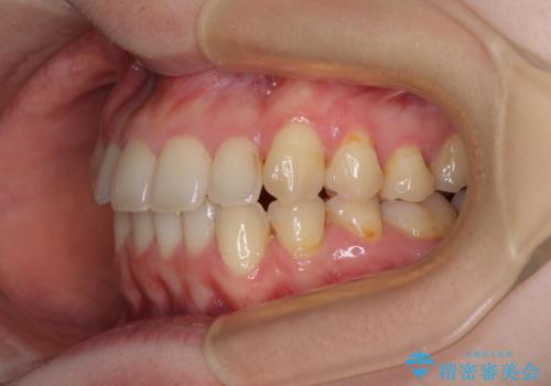 【モニター】1本欠損した下顎前歯と上顎の八重歯 ワイヤー装置で楽して矯正治療の治療後