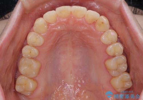 【モニター】1本欠損した下顎前歯と上顎の八重歯 ワイヤー装置で楽して矯正治療の治療後
