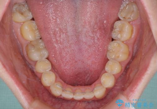 【モニター】1本欠損した下顎前歯と上顎の八重歯 ワイヤー装置で楽して矯正治療の治療後