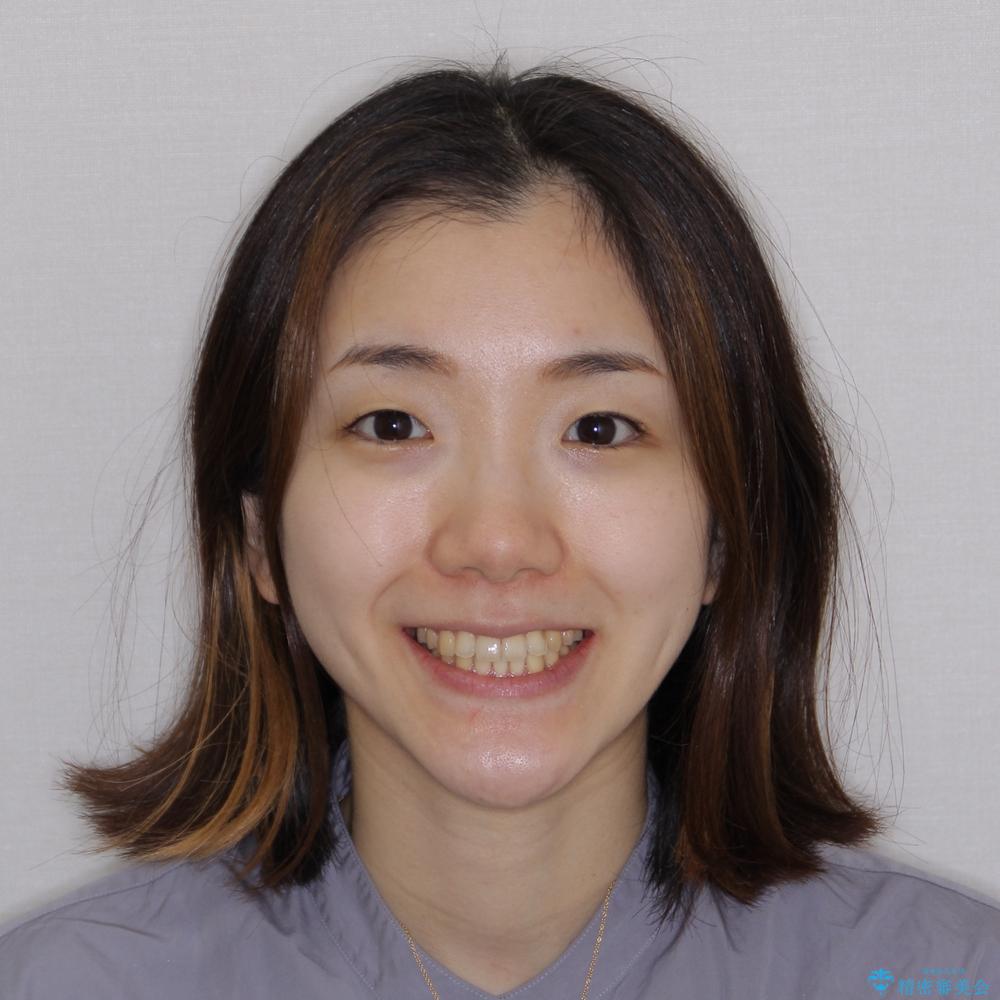 【モニター】1本欠損した下顎前歯と上顎の八重歯 ワイヤー装置で楽して矯正治療の治療後(顔貌)