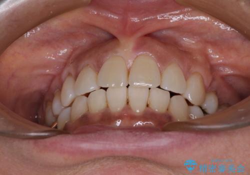 クロスバイトの前歯を治したい ワイヤー装置でも抜歯矯正の治療後