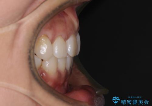 クロスバイトの前歯を治したい ワイヤー装置でも抜歯矯正の治療後