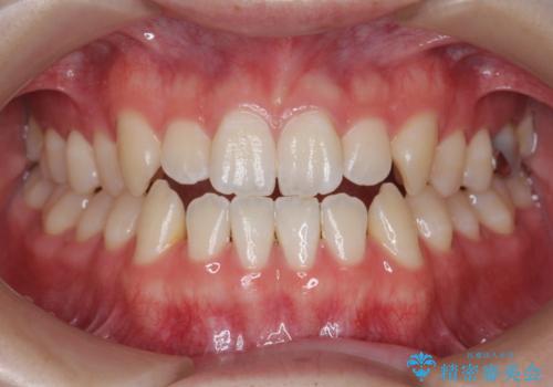 前歯で物を噛みきれない　マウスピース矯正で改善の症例 治療前