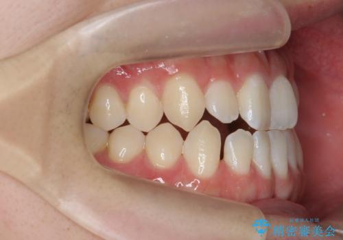 前歯で物を噛みきれない マウスピース矯正で改善の治療前