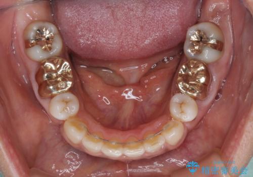 奥歯の銀歯をゴールドに　の症例 治療後
