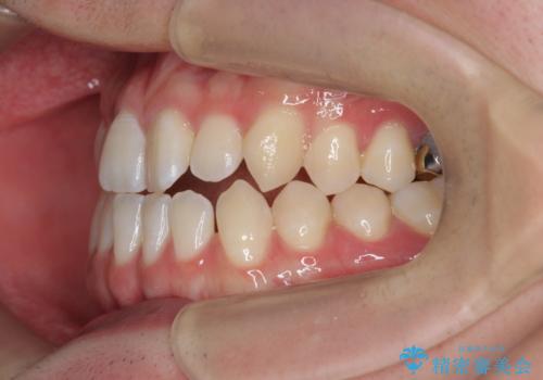 前歯で物を噛みきれない マウスピース矯正で改善の治療前