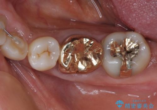 奥歯の銀歯をゴールドに　の治療後