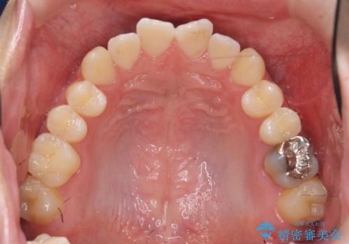 前歯で物を噛みきれない　マウスピース矯正で改善の治療前
