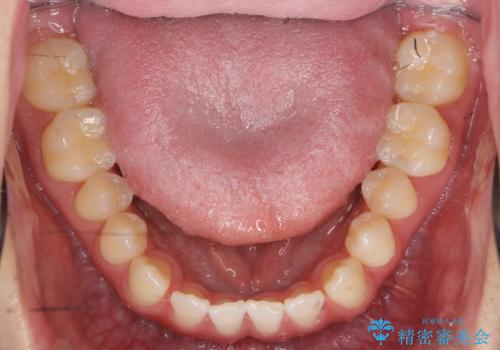 前歯で物を噛みきれない　マウスピース矯正で改善の治療前