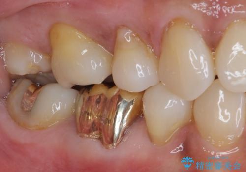 奥歯の銀歯をゴールドに　の治療後