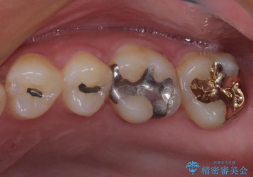 何度も外れてしまう銀歯　ゴールドインレーによる虫歯治療の症例 治療後