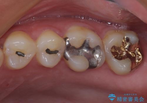 何度も外れてしまう銀歯 ゴールドインレーによる虫歯治療の治療後