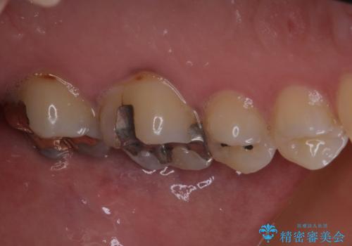 何度も外れてしまう銀歯 ゴールドインレーによる虫歯治療の治療後